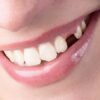 Mơ gãy răng báo điềm gì: Giải mã tổng quát mơ thấy gãy răng