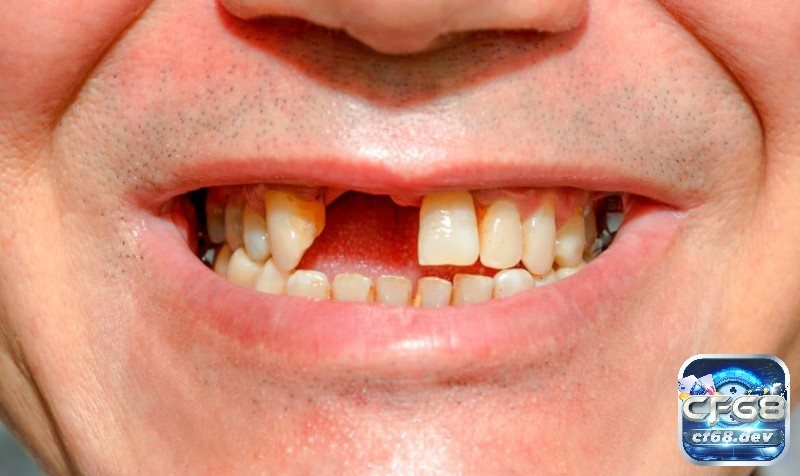 Mơ thấy gãy nhiều răng báo hiệu mạnh mẽ những biến động cực kỳ lớn trong cuộc sống.